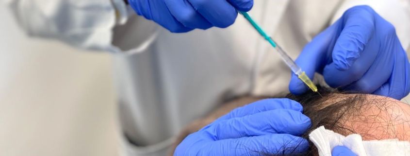 Prof. Dr. Ockenfels injiziert Stammzellen in die Kopfhaut im Rahmen einer Therapie zur Haarverpflanzung.